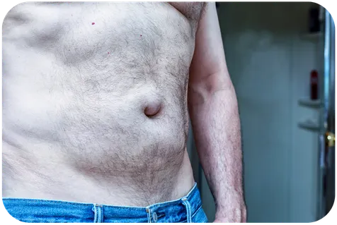 Ilustración médica de una hernia inguinal mostrando el tejido que sobresale por la pared abdominal